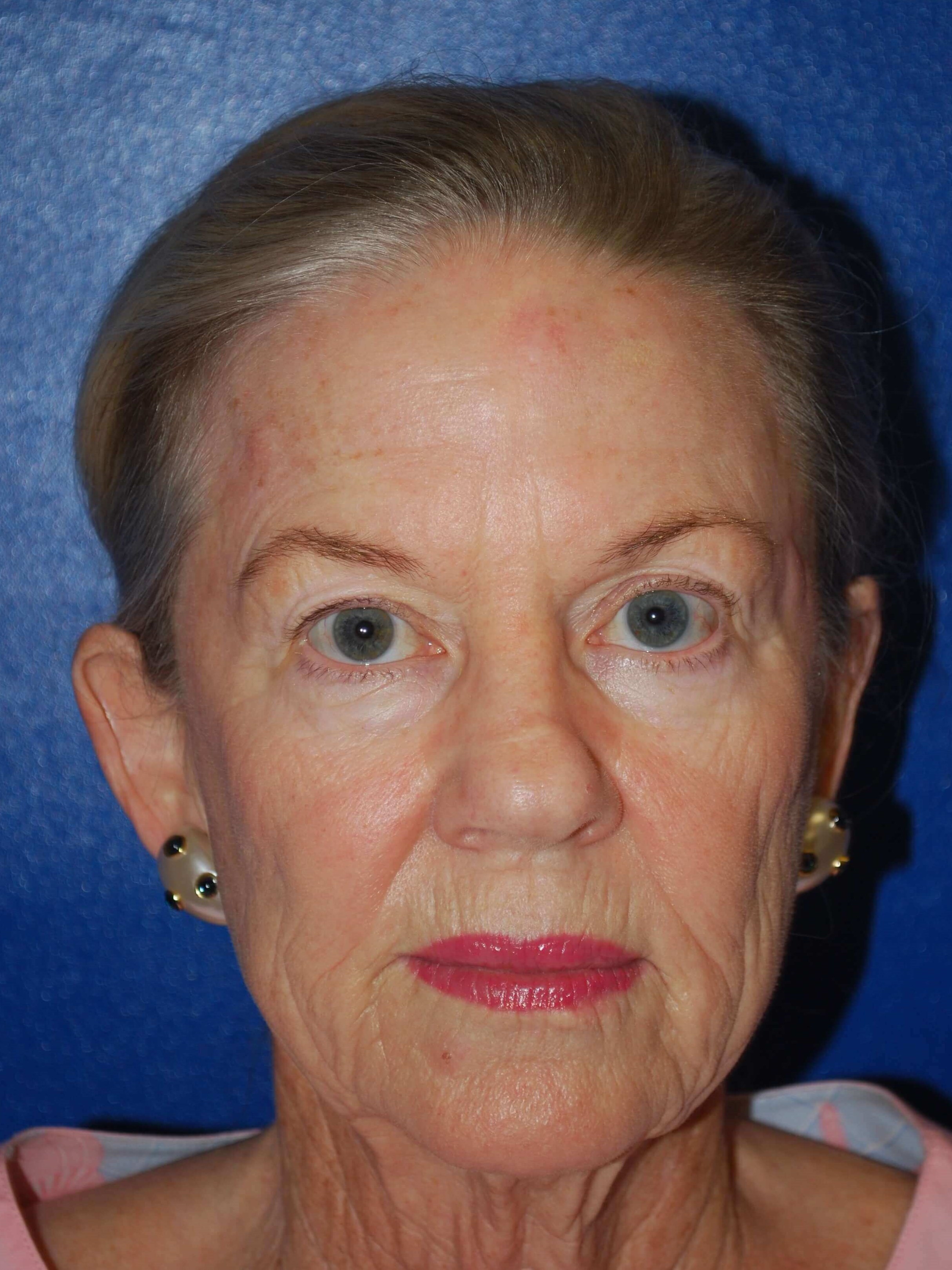 Laser Resurfacing Before