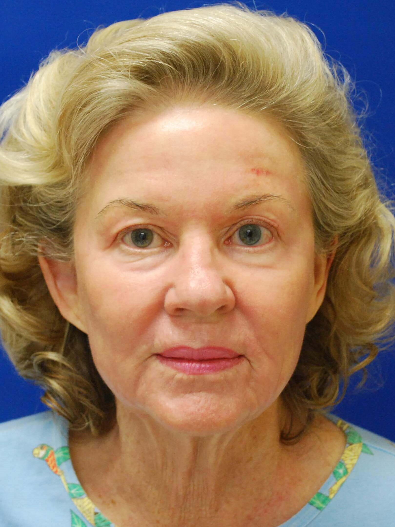 Laser Resurfacing After