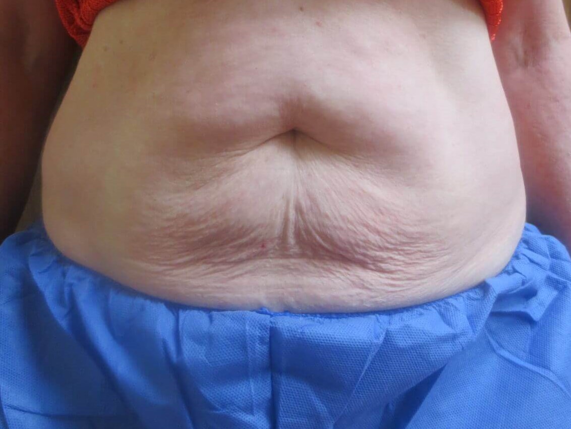 BodyFX to abdomen Before