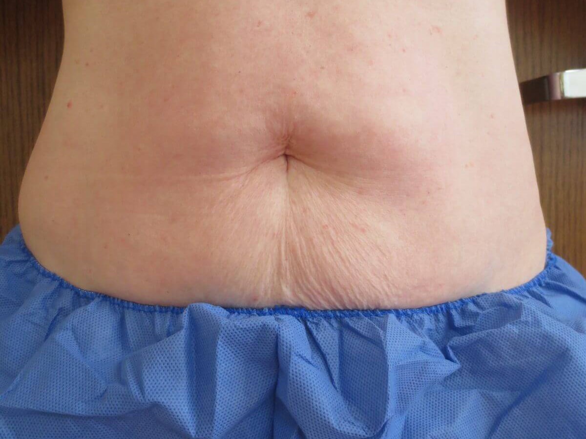 BodyFX to abdomen After