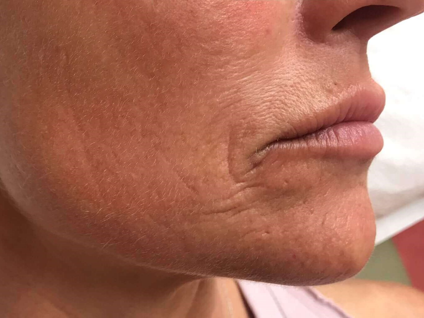 Laser Resurfacing After