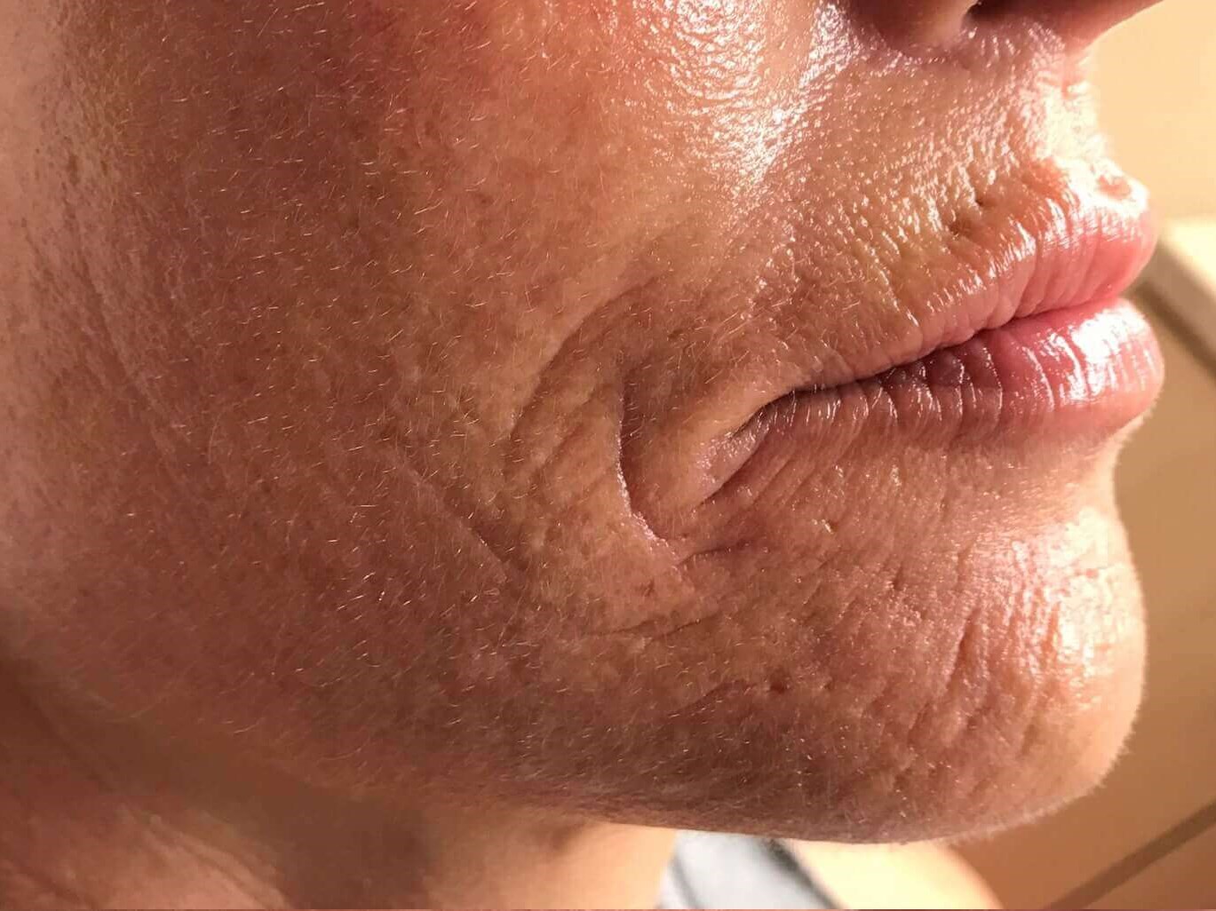 Laser Resurfacing Before
