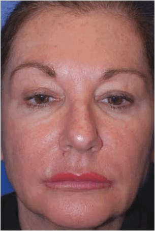 Laser Resurfacing Before