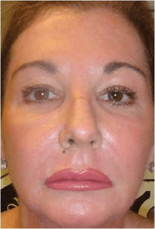Laser Resurfacing After