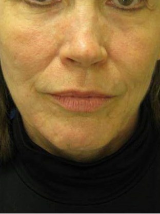 Sculptra Before