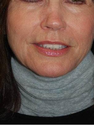 Sculptra After