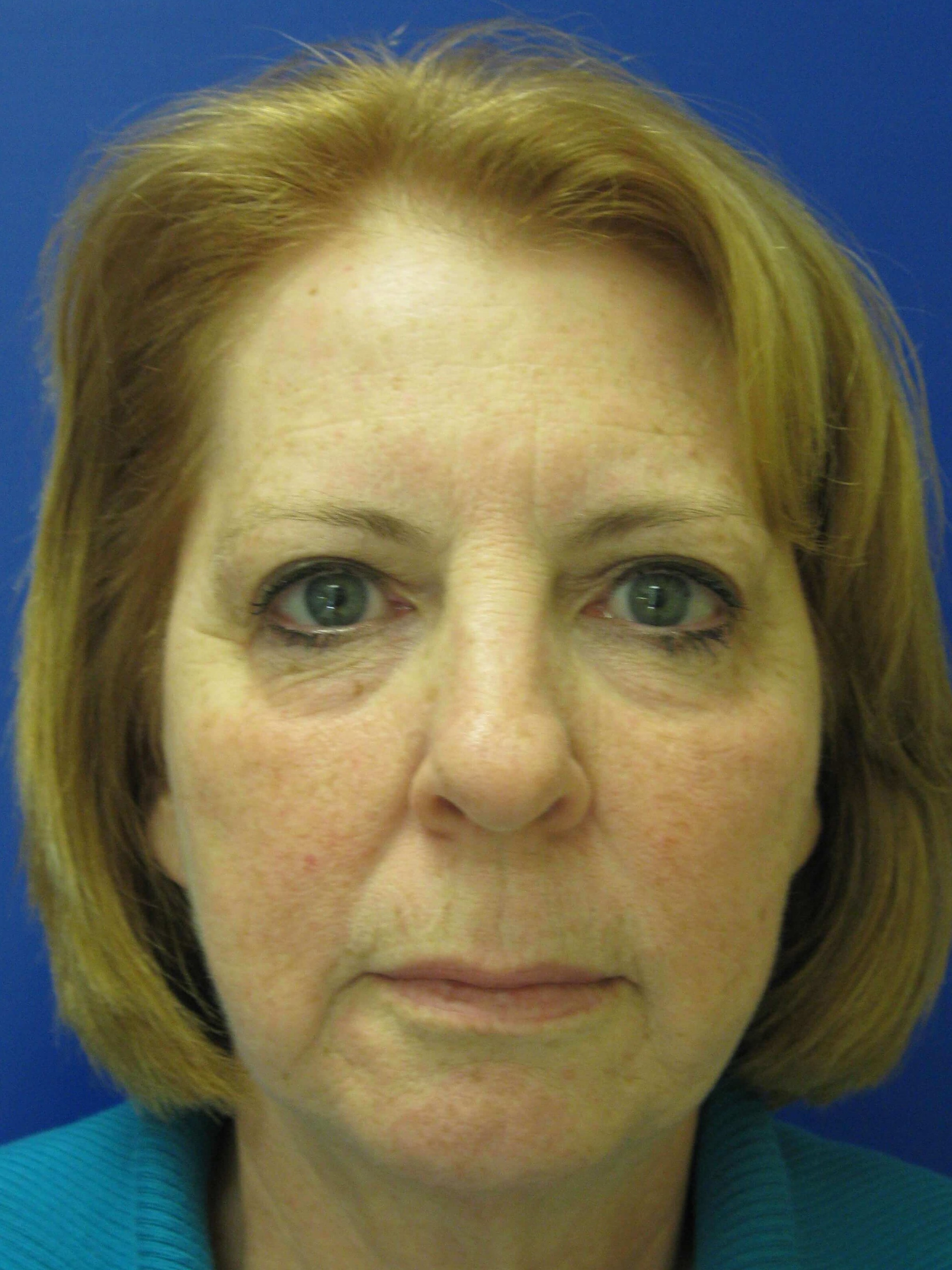 Sculptra Before
