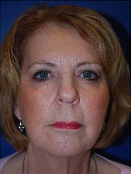 Sculptra After