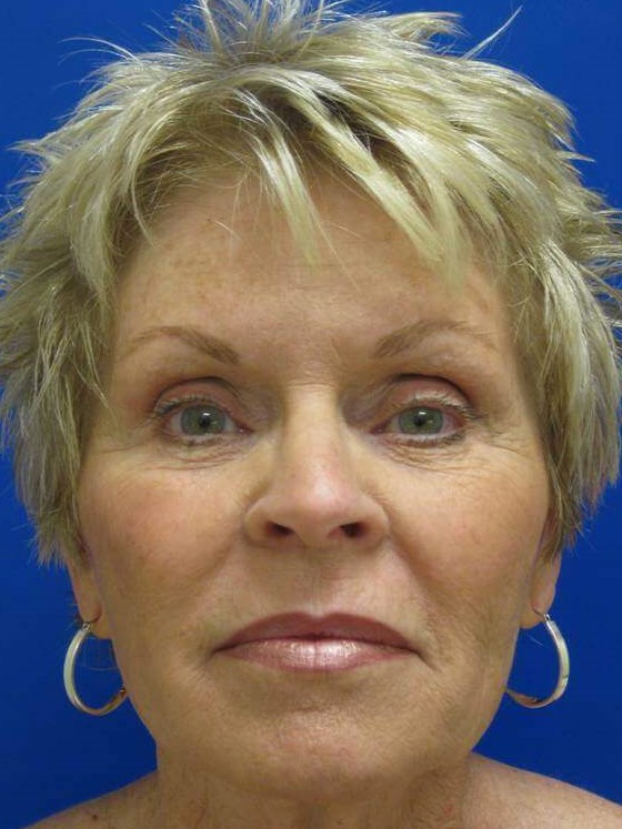 Filler and IPL After