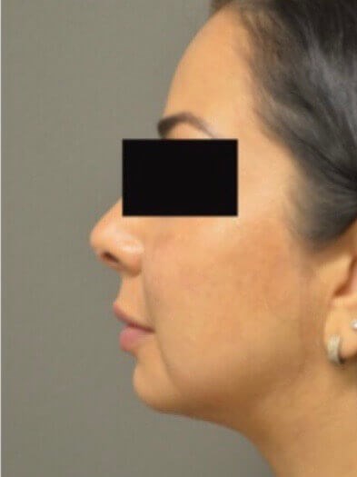 Kybella Before