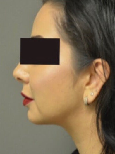 Kybella After