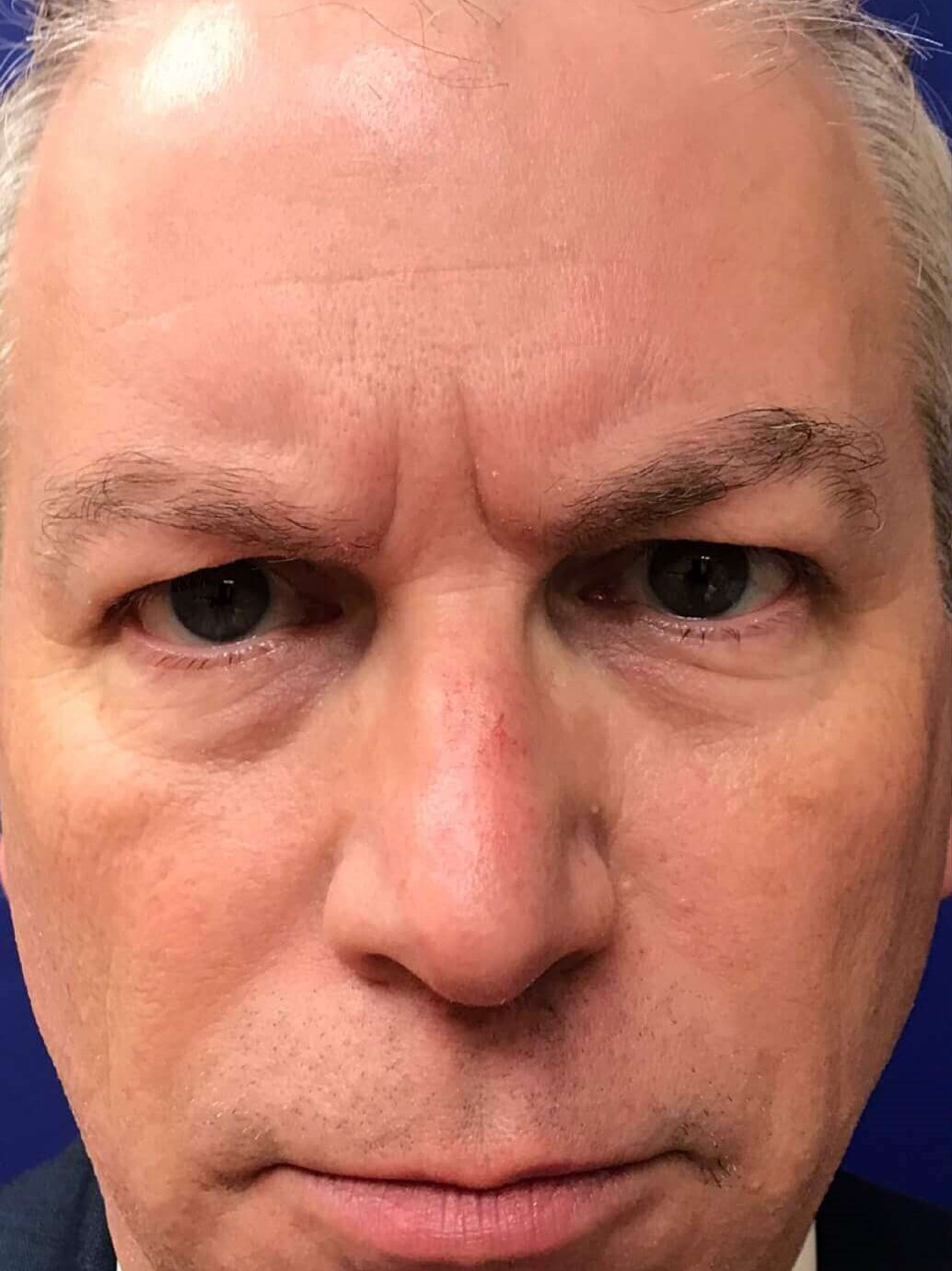 Dysport in a Male Patient Before