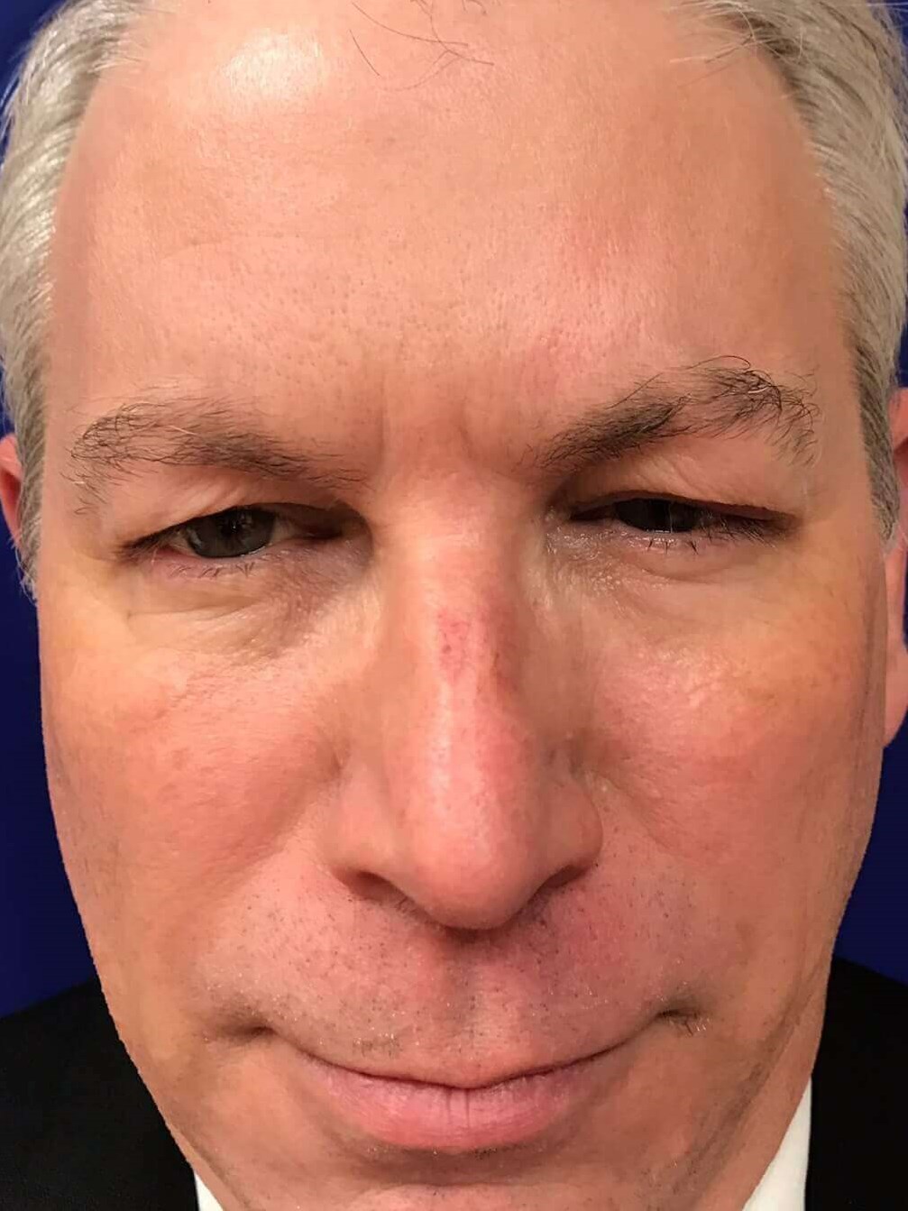 Dysport in a Male Patient After