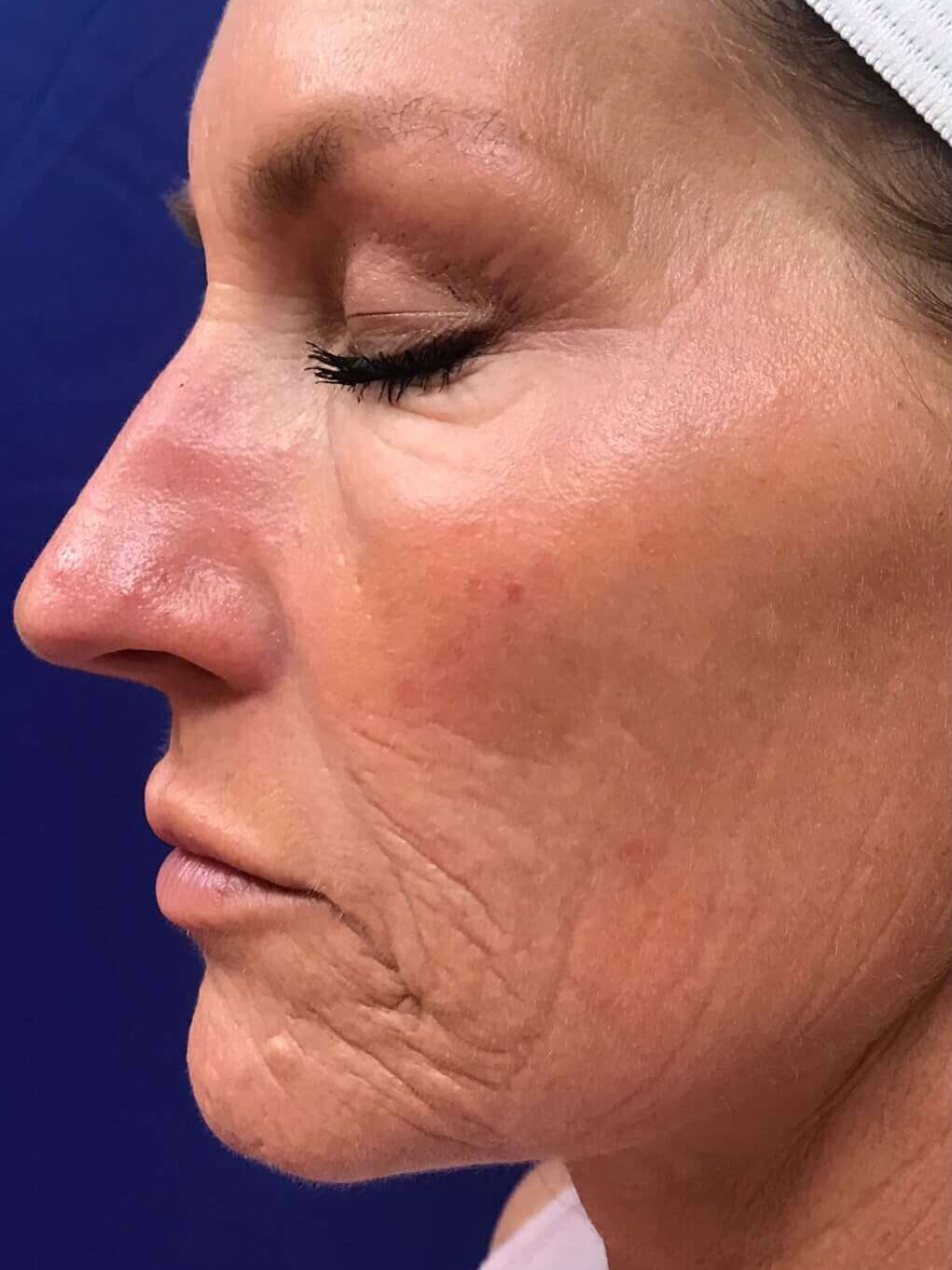 Laser Resurfacing Before
