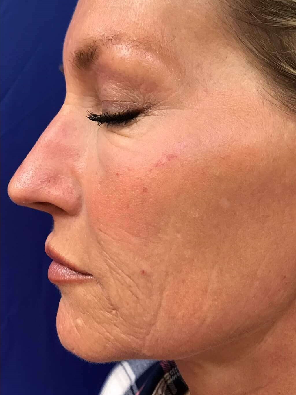 Laser Resurfacing After
