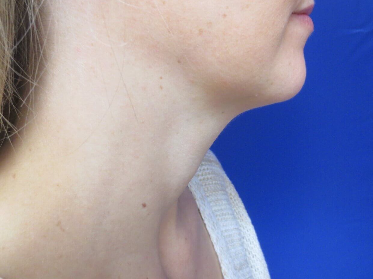 Kybella Before