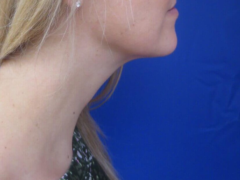 Kybella After