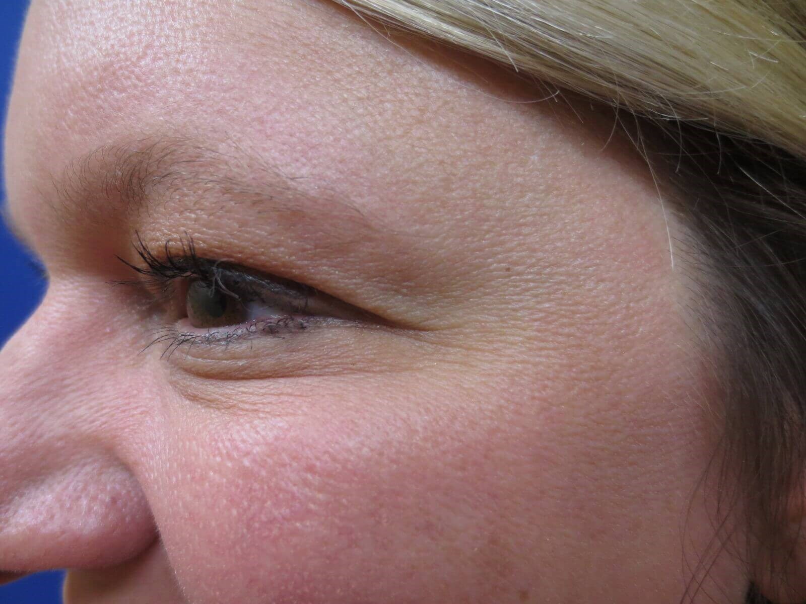 Botox After