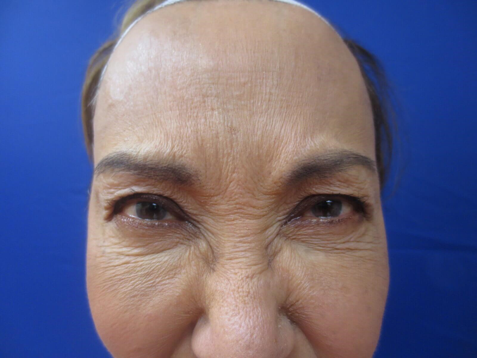 BOTOX Before