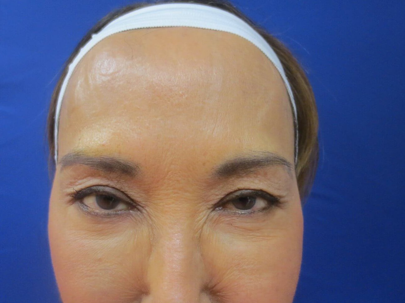 BOTOX After