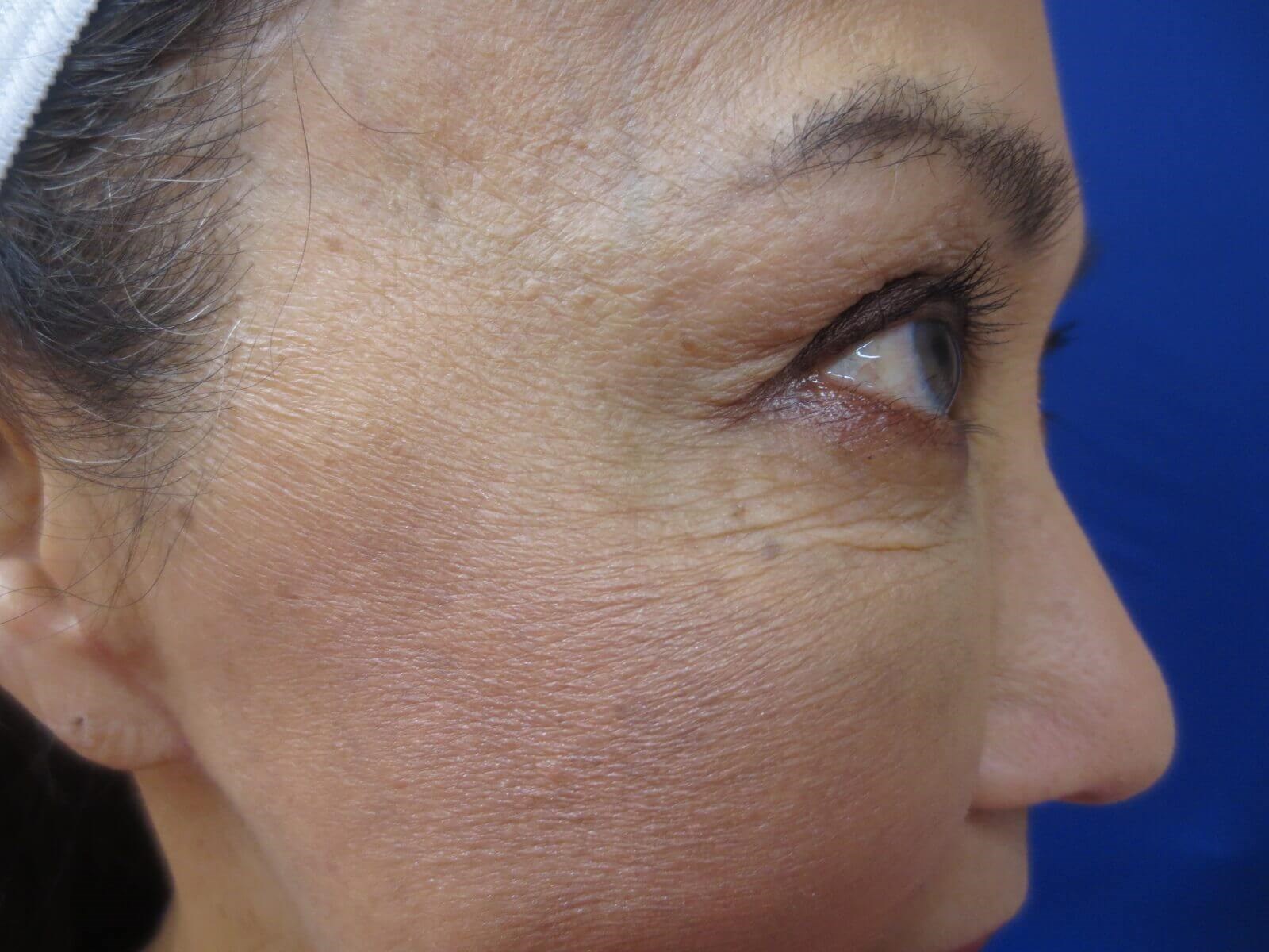 BOTOX Before