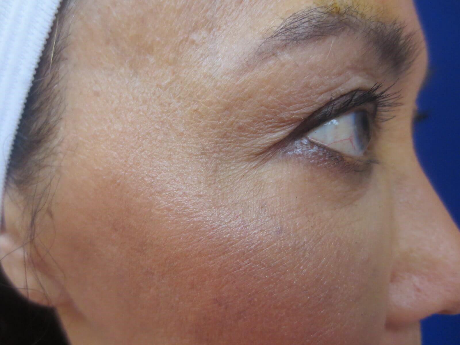 BOTOX After