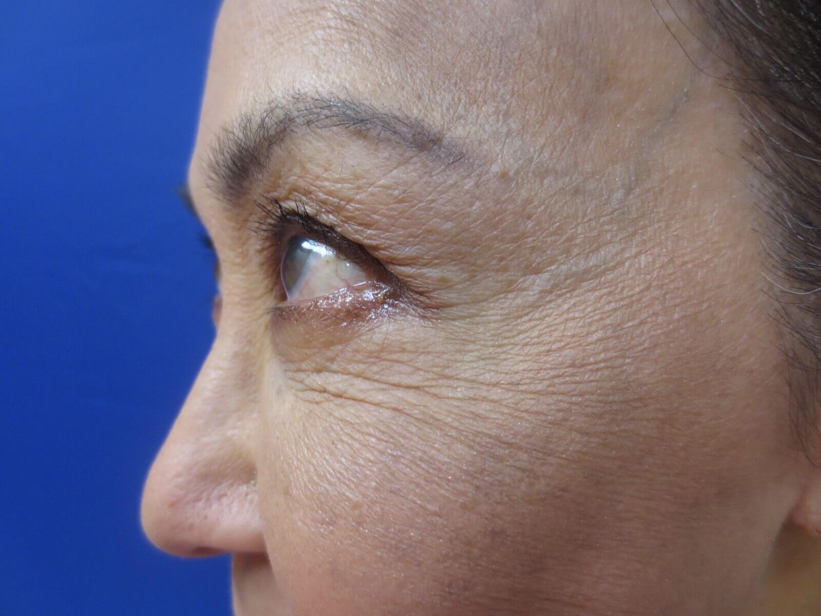 BOTOX Before