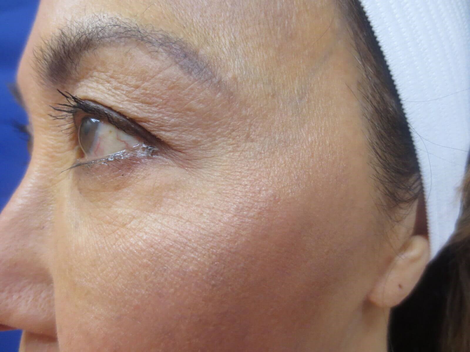 BOTOX After