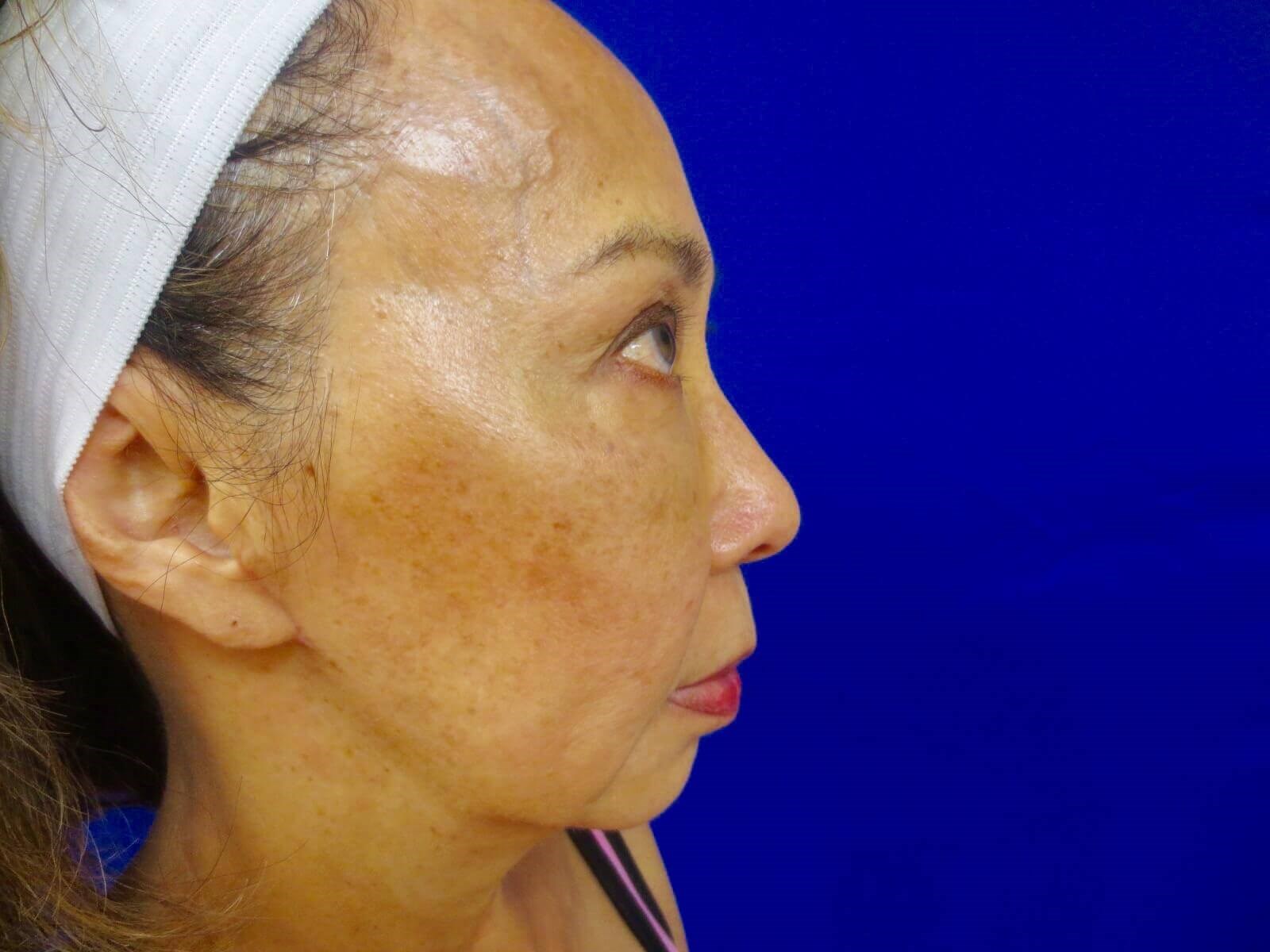 Lumecca IPL Before