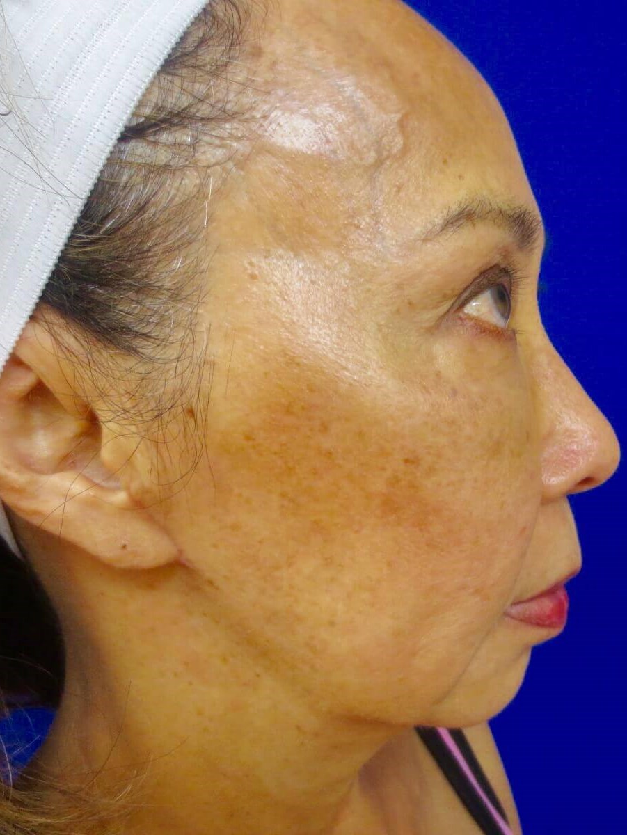 Lumecca IPL Before