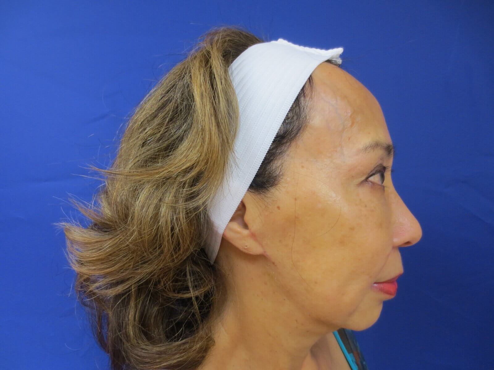 Lumecca IPL After