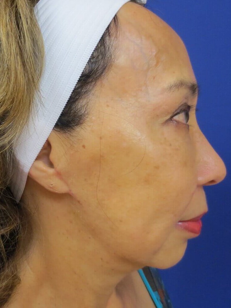 Lumecca IPL After
