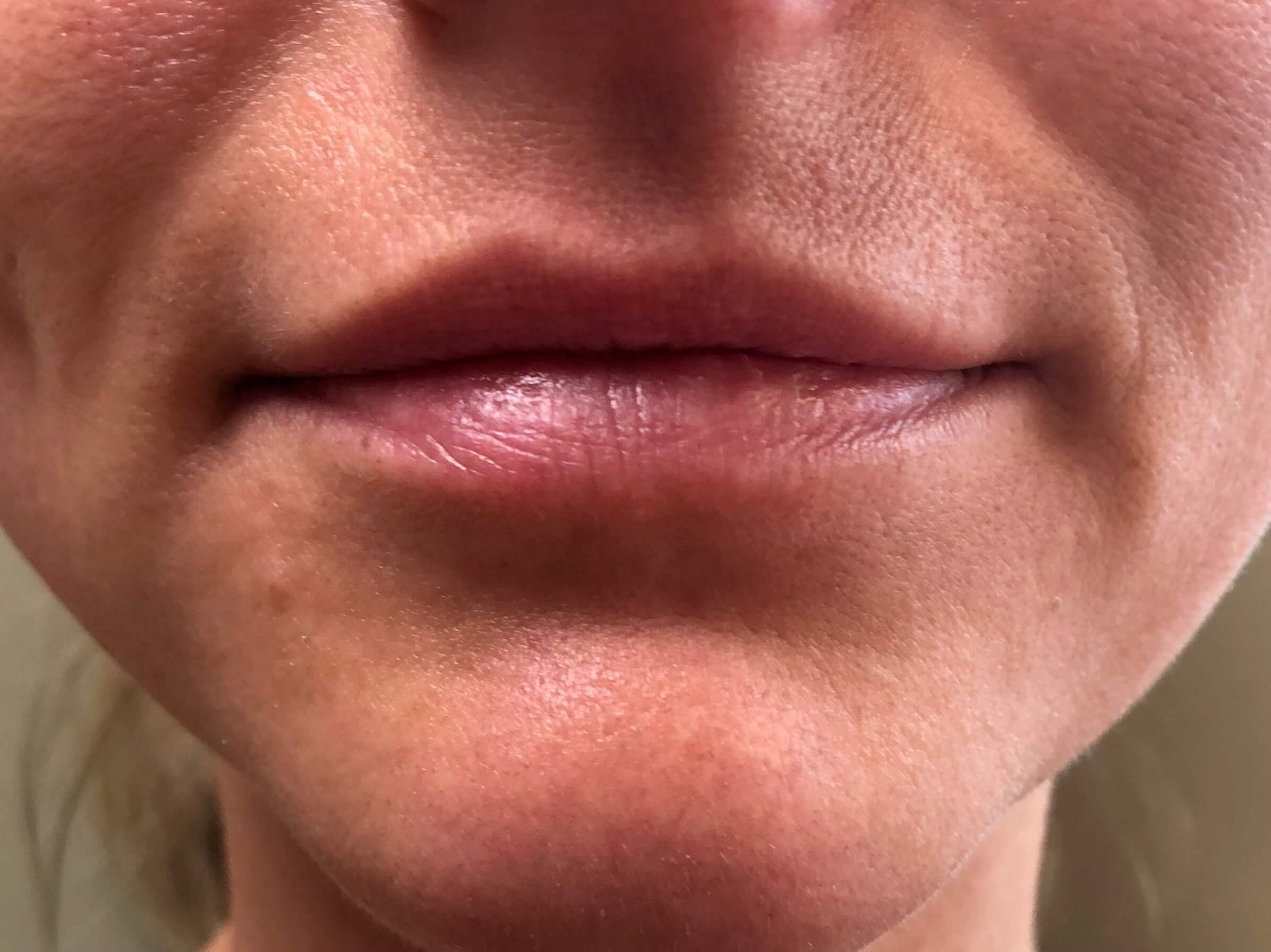 VERSA LIP FILLER